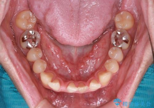 【前歯の隙間】インビザラインですきっ歯の矯正治療の治療前