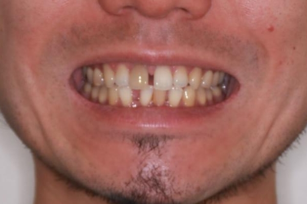 【前歯の隙間】インビザラインですきっ歯の矯正治療の治療前（顔貌）