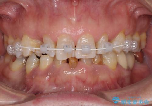 乳歯や矮小歯の多い前歯　部分矯正と補綴治療による審美歯科治療の治療中