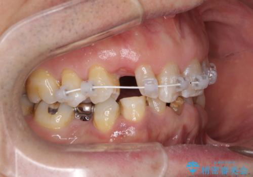 乳歯や矮小歯の多い前歯 部分矯正と補綴治療による審美歯科治療の治療中