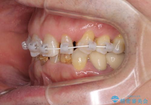 乳歯や矮小歯の多い前歯 部分矯正と補綴治療による審美歯科治療の治療中