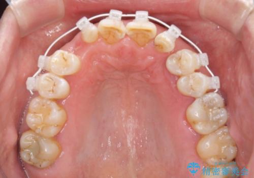 乳歯や矮小歯の多い前歯 部分矯正と補綴治療による審美歯科治療の治療中