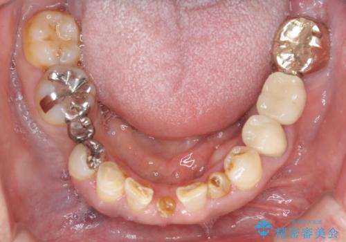 乳歯や矮小歯の多い前歯 部分矯正と補綴治療による審美歯科治療の治療中