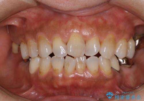 虫歯予防、歯周病予防のためにクリーニングの治療前