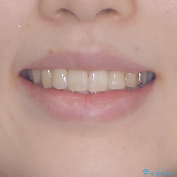 短期間での治療 急速拡大装置を併用したワイヤー装置による矯正治療の治療後(顔貌)