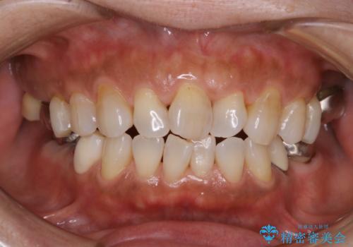 虫歯予防、歯周病予防のためにクリーニングの治療後