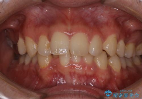 結婚式前にPMTCとホワイトニングの治療前