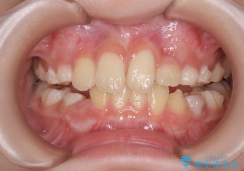 過剰歯を抜歯して前歯を排列 インビザライン・ファーストによる小学生のⅠ期治療の治療中