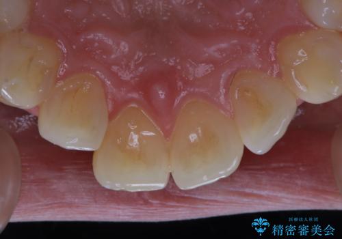 結婚式前にPMTCとホワイトニングの治療前