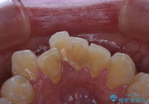 結婚式前にPMTCとホワイトニングの治療前