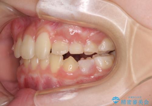 過剰歯を抜歯して前歯を排列　インビザライン・ファーストによる小学生のⅠ期治療の治療中