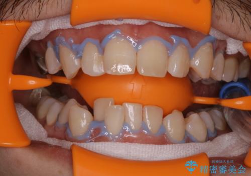 結婚式前にPMTCとホワイトニングの治療中