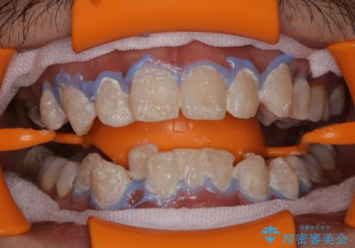 結婚式前にPMTCとホワイトニングの治療中