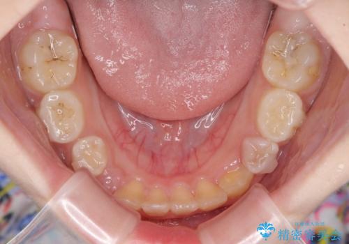 過剰歯を抜歯して前歯を排列 インビザライン・ファーストによる小学生のⅠ期治療の治療中