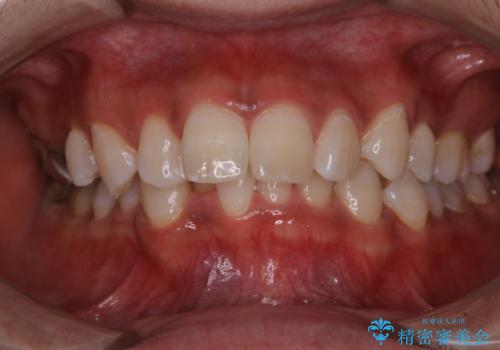 結婚式前にPMTCとホワイトニングの治療後