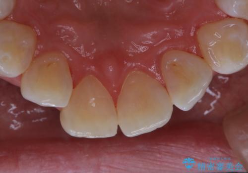 結婚式前にPMTCとホワイトニングの治療後