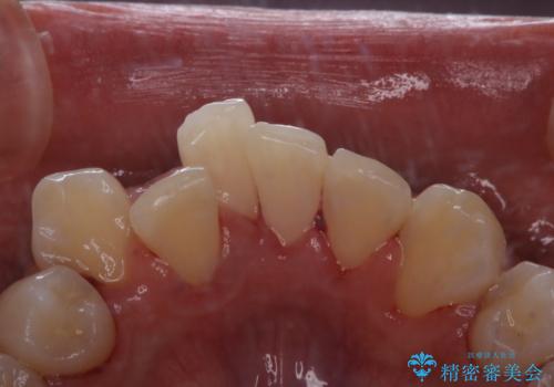 結婚式前にPMTCとホワイトニングの治療後