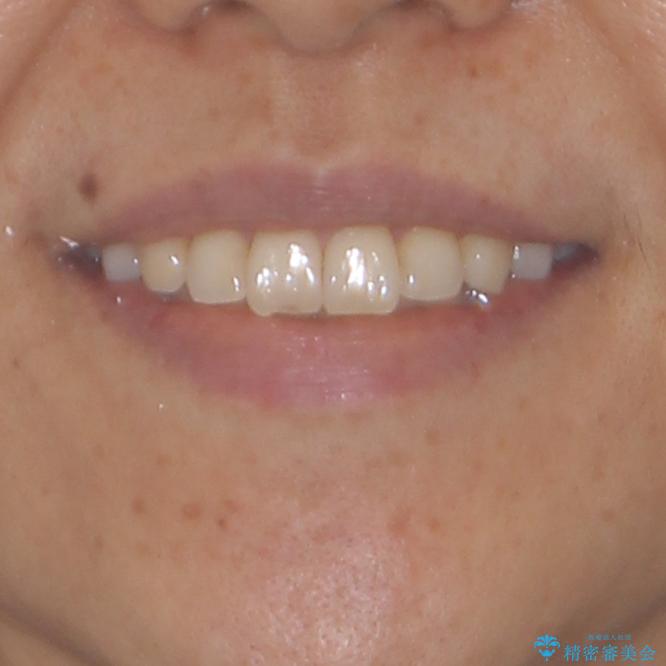 痛む奥歯と矯正の後戻り インビザライン・ライトとセラミック治療の治療後(顔貌)