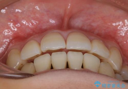八重歯がスッキリ 抜歯ワイヤー矯正の治療後