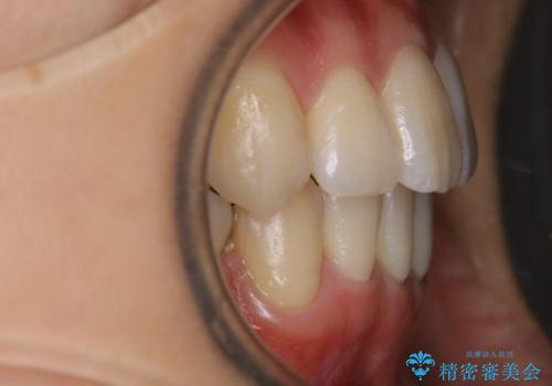 八重歯がスッキリ 抜歯ワイヤー矯正の治療後