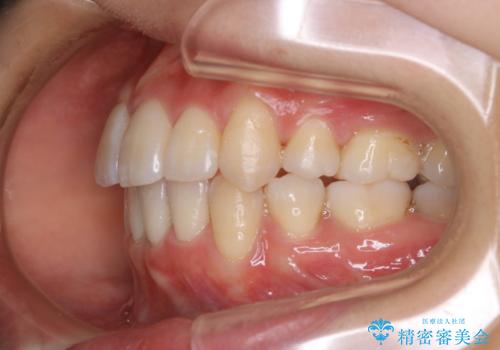 八重歯がスッキリ 抜歯ワイヤー矯正の治療後