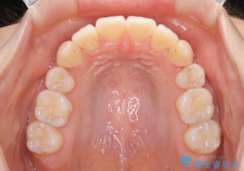 八重歯がスッキリ 抜歯ワイヤー矯正の治療後