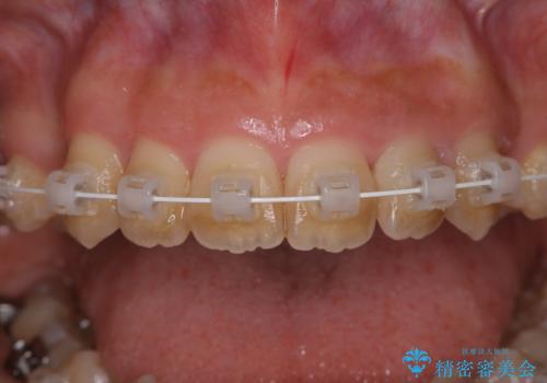 ワイヤー矯正中のクリーニングの治療前