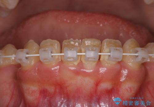 ワイヤー矯正中のクリーニングの治療前