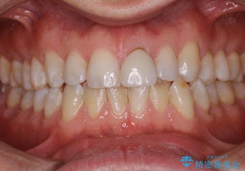 年末のお口の大掃除 PMTCの治療前