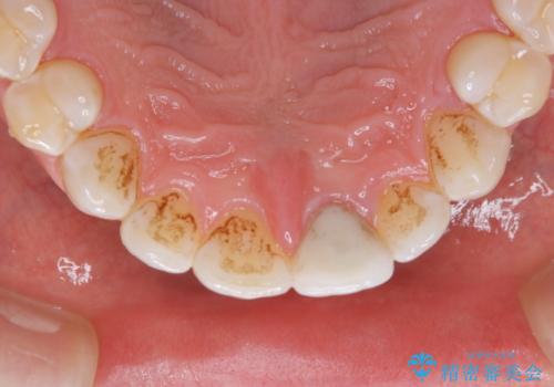 年末のお口の大掃除 PMTCの治療前