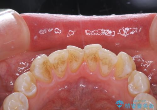 年末のお口の大掃除 PMTCの治療前