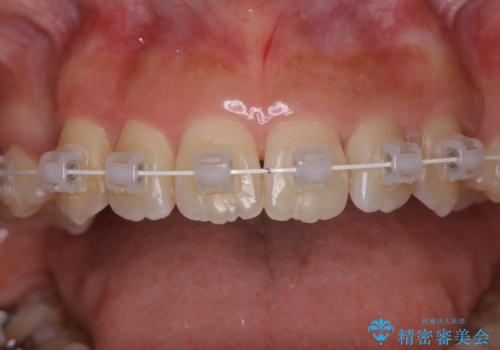 ワイヤー矯正中のクリーニングの治療後