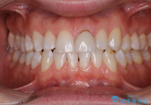 年末のお口の大掃除 PMTCの治療後