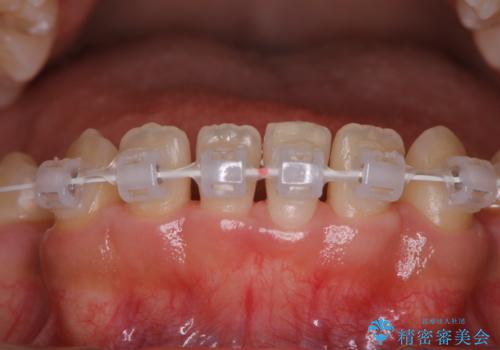 ワイヤー矯正中のクリーニングの治療後