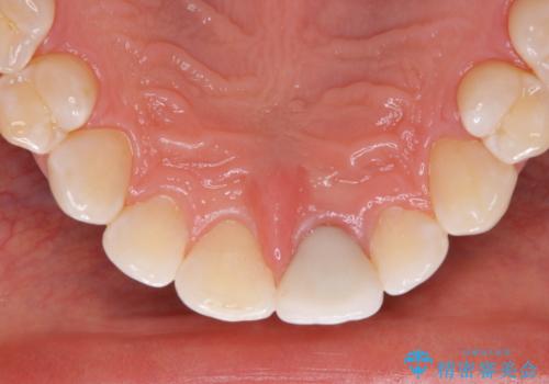 年末のお口の大掃除 PMTCの治療後