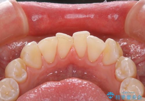 年末のお口の大掃除 PMTCの治療後