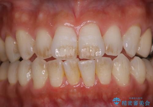 1年ぶりにコーヒーによる着色落とし PMTC