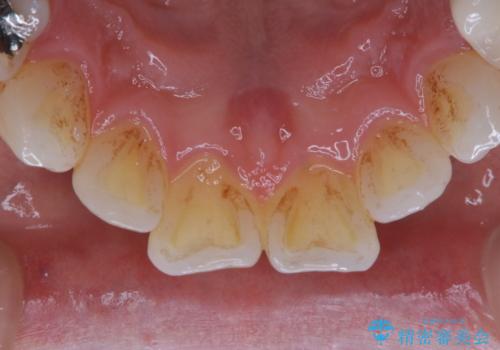 1年ぶりにコーヒーによる着色落とし PMTCの治療前