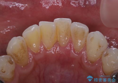 1年ぶりにコーヒーによる着色落とし PMTCの治療前
