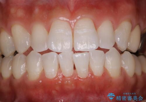 1年ぶりにコーヒーによる着色落とし PMTCの治療後