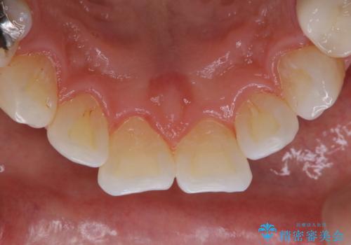 1年ぶりにコーヒーによる着色落とし PMTCの治療後
