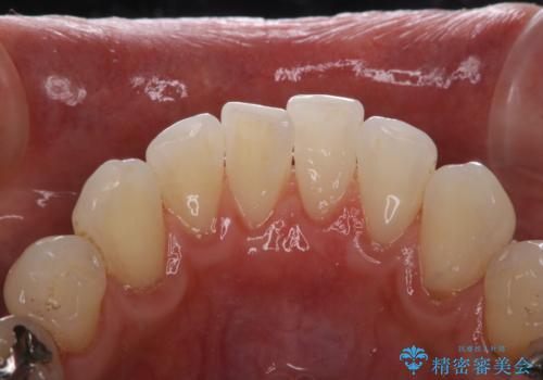 1年ぶりにコーヒーによる着色落とし PMTCの治療後