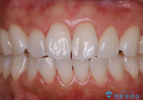 後戻り防止の為のホワイトニングの治療後
