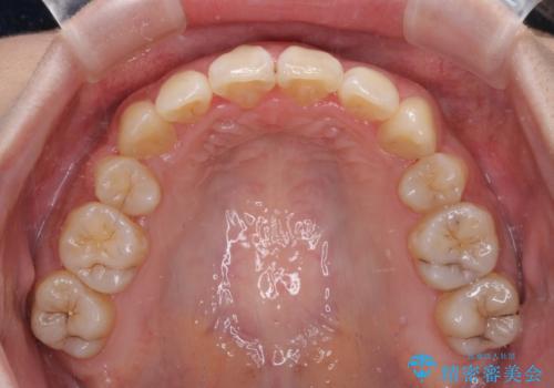 補助装置を使ったインビザラインによる抜歯矯正の治療中