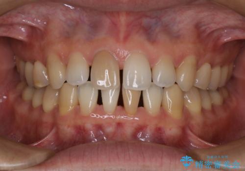 【前歯の隙間】インビザラインですきっ歯の矯正治療の治療中