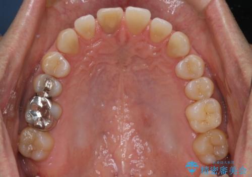 【前歯の隙間】インビザラインですきっ歯の矯正治療の治療中