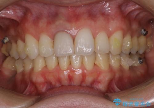 歯列矯正中にPMTCの治療前