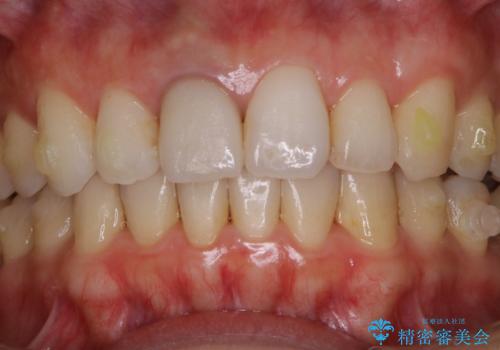歯列矯正中にPMTCの治療前