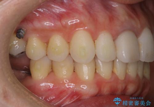 歯列矯正中にPMTCの治療前