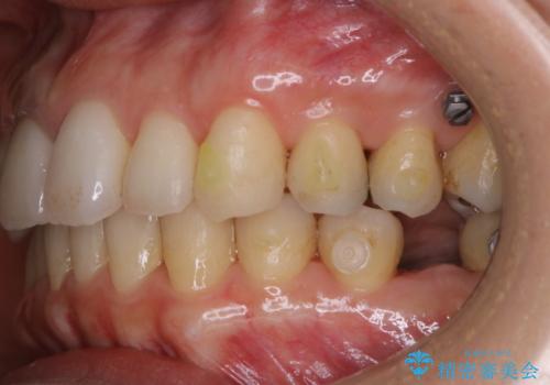 歯列矯正中にPMTCの治療前